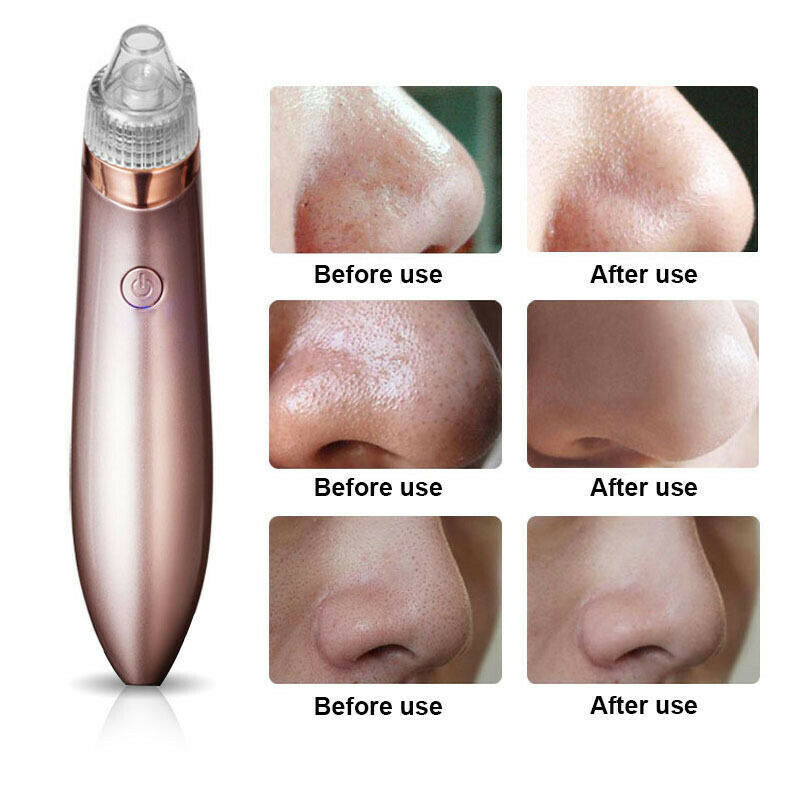 Electric Blackhead Vacuum Pore Cleaner and Acne Pimple Remover