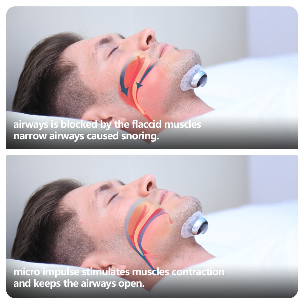 Electronic Anti-Snoring Muscle Stimulator Device